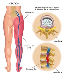 6 Natural Solutions for the Inhumane Cruelty of Sciatica Chiropractor in Westlake, OH